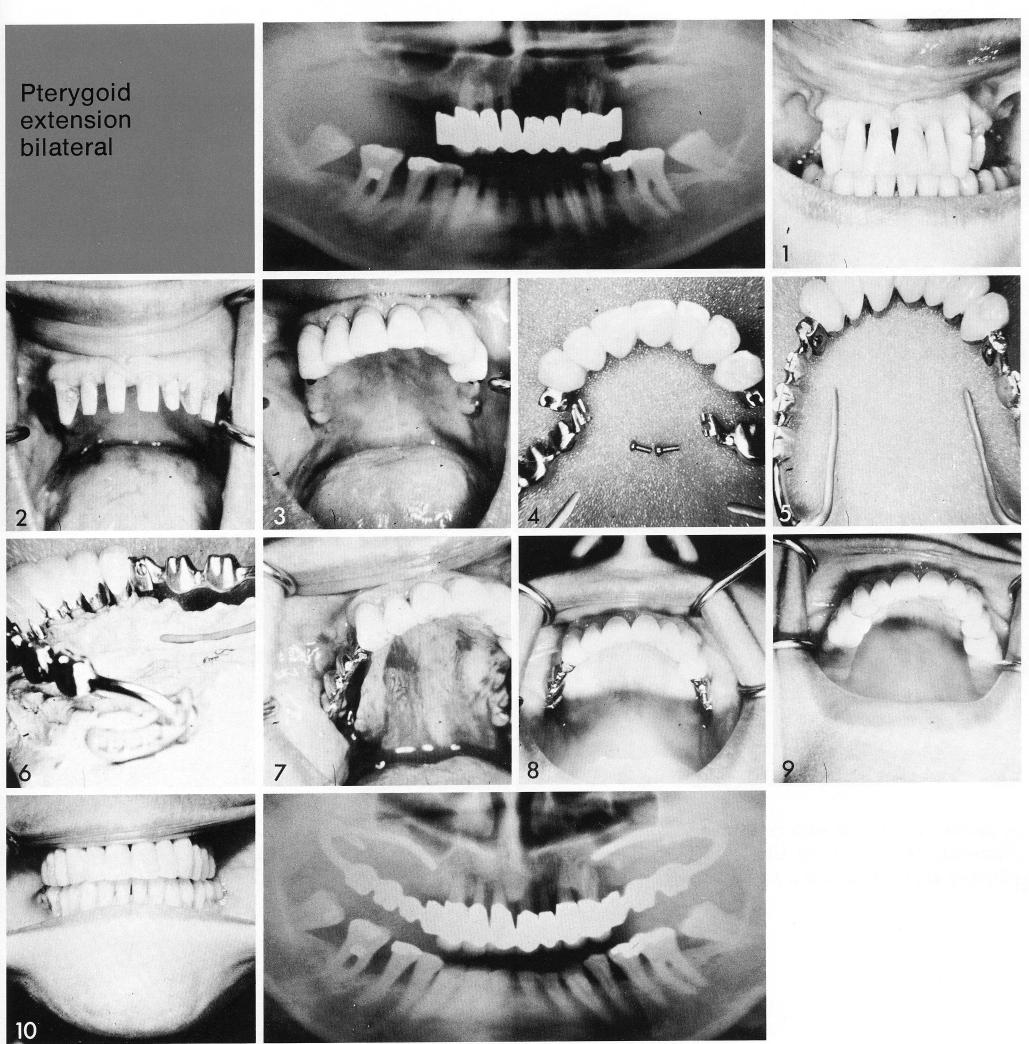 1 Male and female attachments in bilateral pterygoid extension implants 