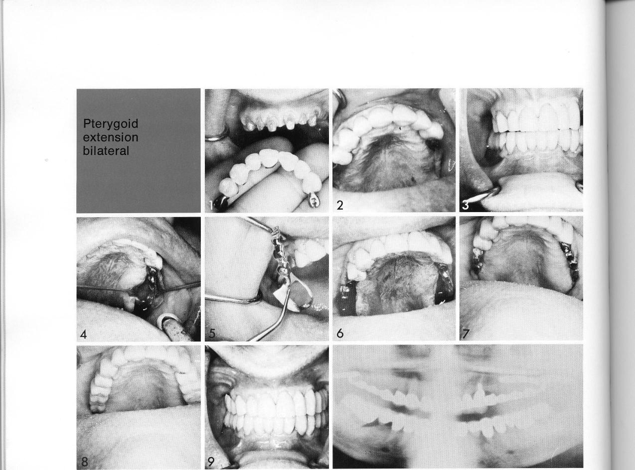1 Maxillary partial restoration with copings fitted to prepared teeth