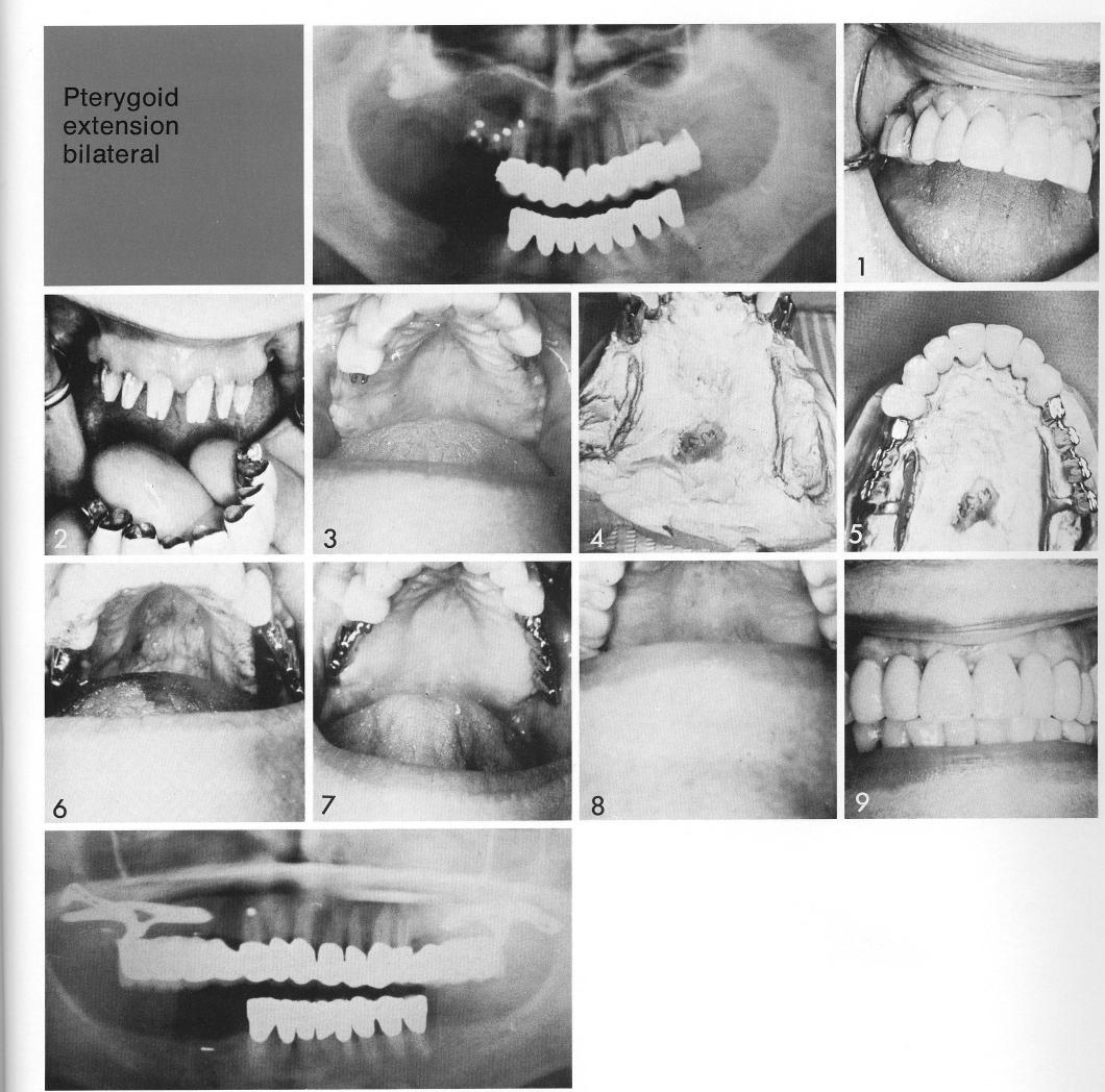 1 Bilateral maxillary pterygoid extension implants design on stone model