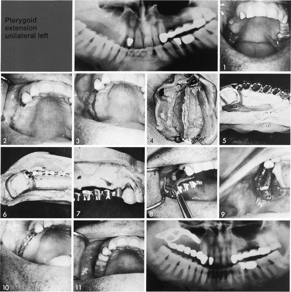 1 Maxillary tooth prepared to support a restoration