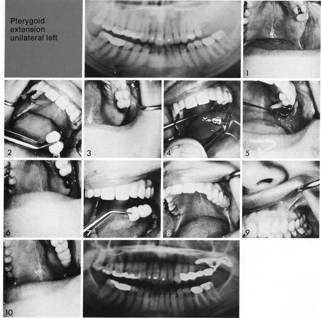 1 Maxillary sinus had ballooned backward and downward into the tuberosity  