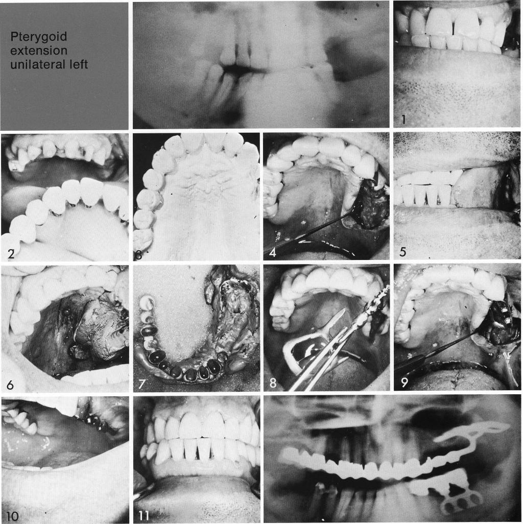 1 Three quarter maxillary arch restoration made for the remaining teeth