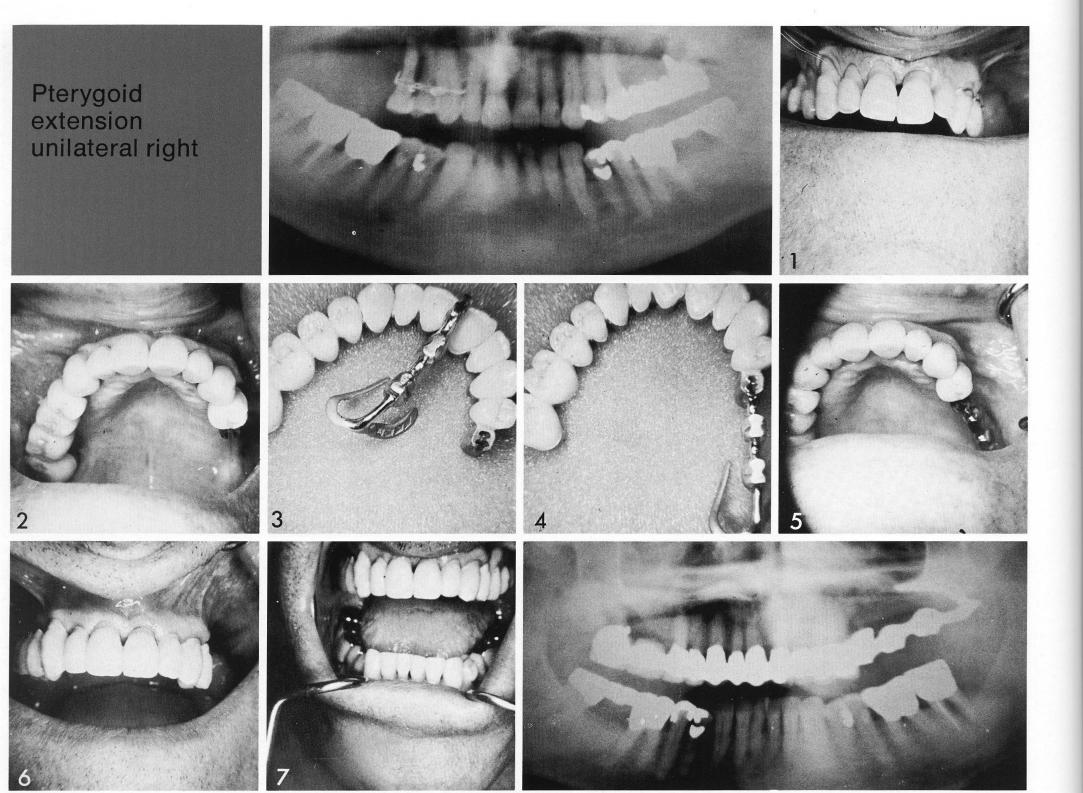 1 Impression for maxillary three unit splint to complete the restoration