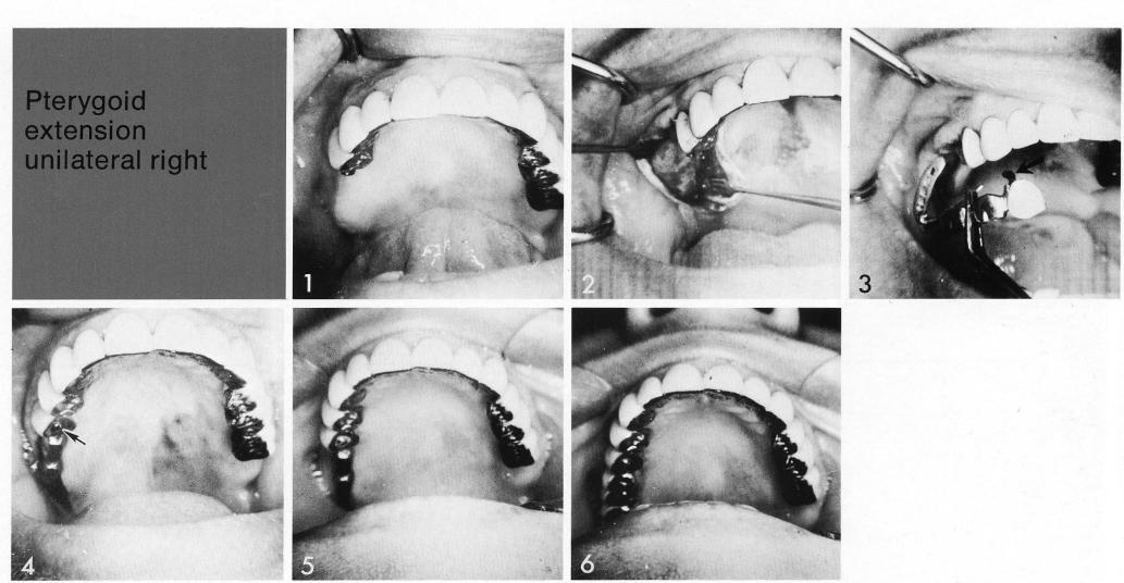 1 Pontic cantilevered of maxillary restoration has internal screw system