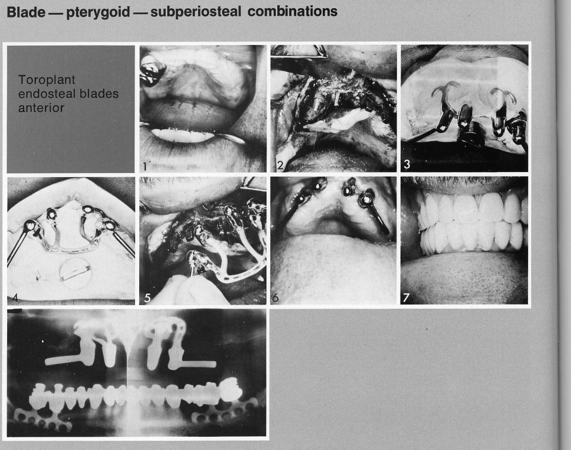 1 The maxillary natural and artificial abutment supported toroplant