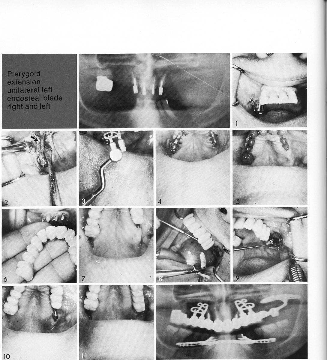 1 A maxillary bladevent implant inserted in a very narrow arch