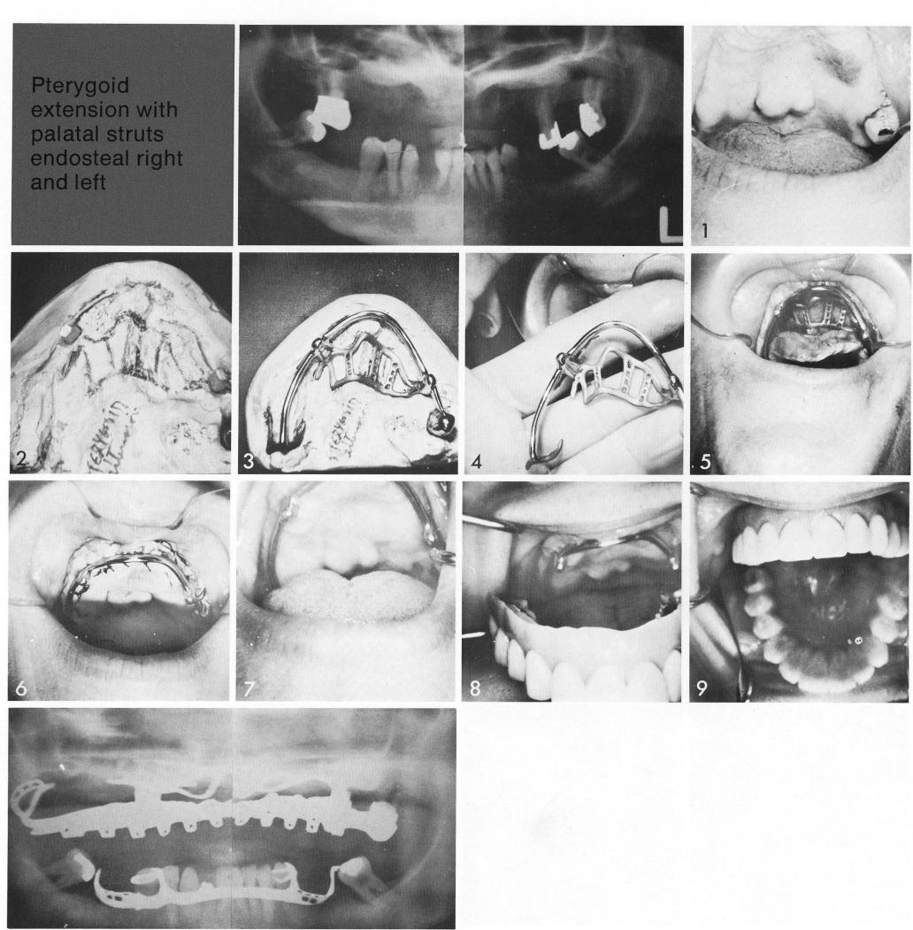 1 Large palatine torus and uneven maxillary ridge resorption for implant