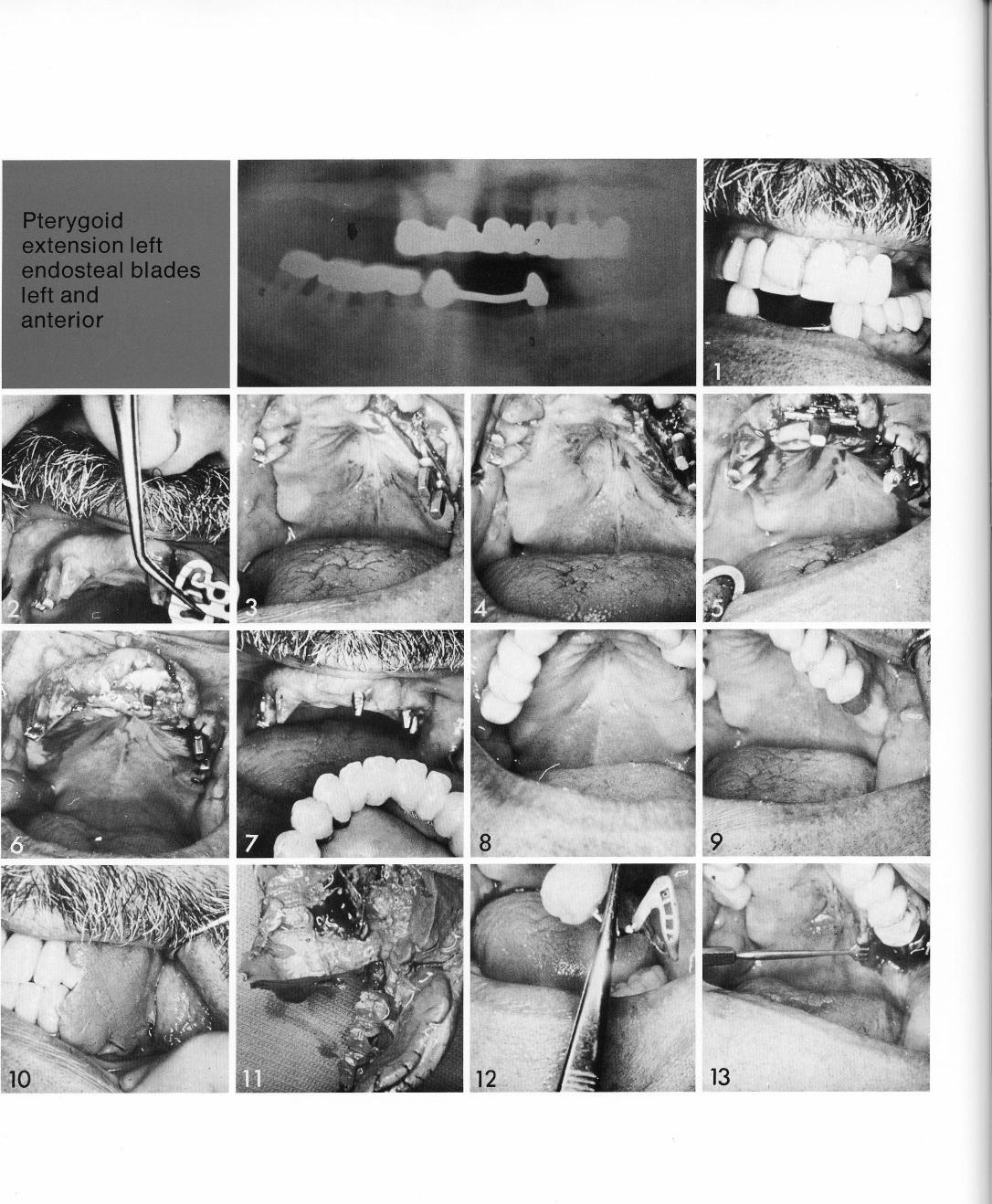 1 Maxillary endosteal blades and sinus circumventing blade implants