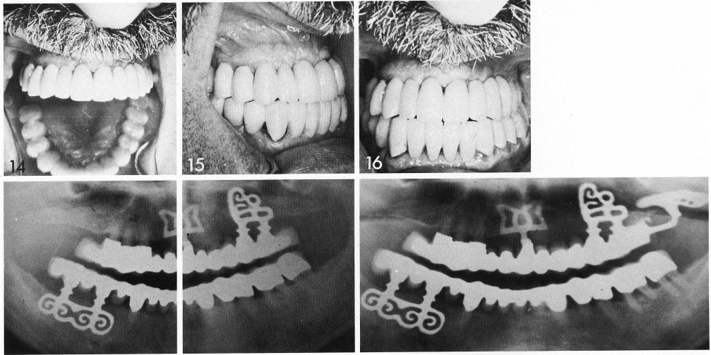 1 A maxillary full arch fixed prosthesis inserted over the implants