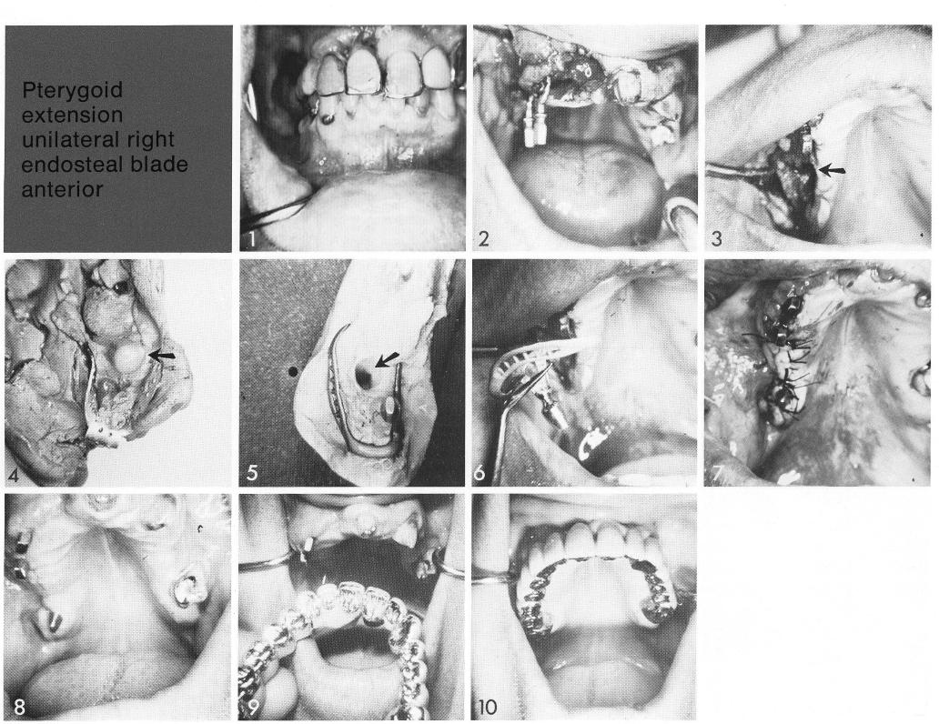 1 Short span of maxillary bone exists between the open socket and sinus