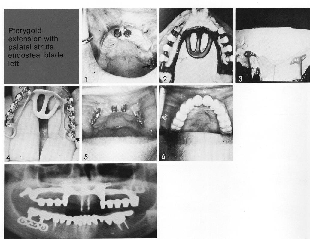 1 Posterior maxillary bladevent implant extends into a sturdy tuberosity 