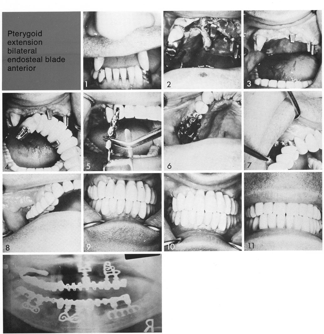 1 Maxillary bladevent implant inserted between the arch midline