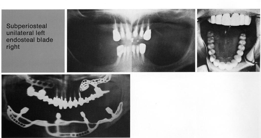 1 Full maxillary arch restoration used with the natural teeth as support