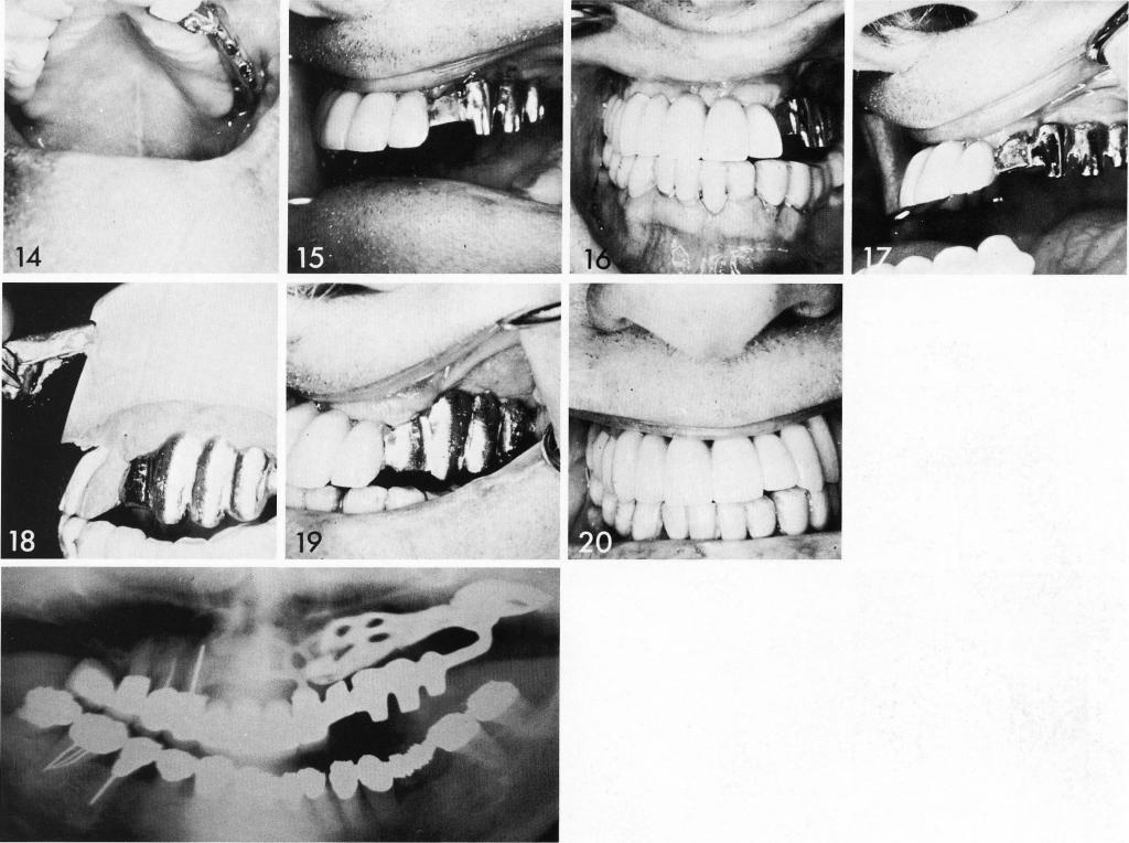 1 The maxillary pterygoid extension implant inserted