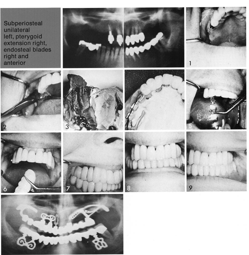 1 Pterygoid extension implant added to implant supported restoration