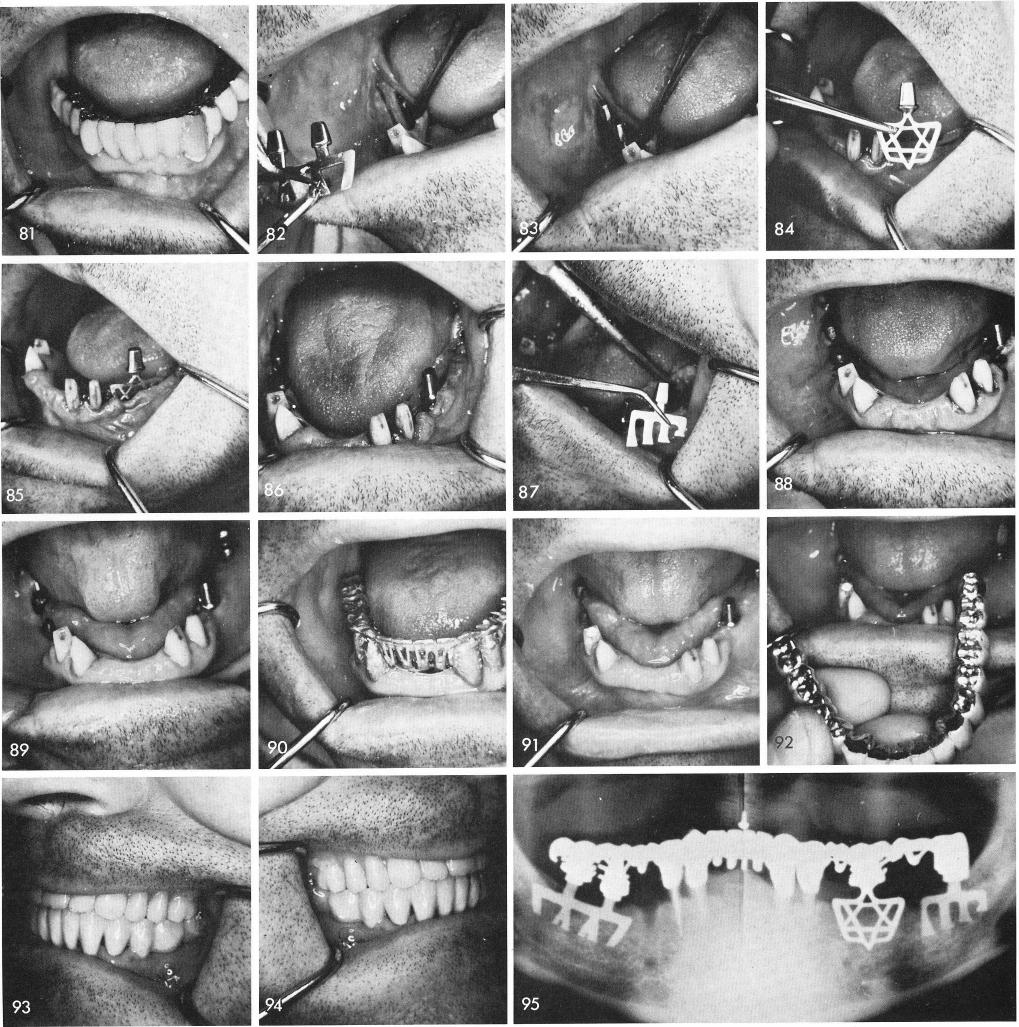 1 Vitallium Star of David mandibular implant design