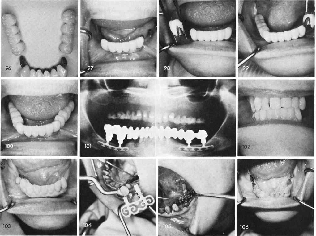 1 Mandibular telescopic crowns cemented directly over the pontics