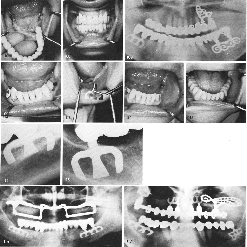 1 Early designed mandibular type blade implants
