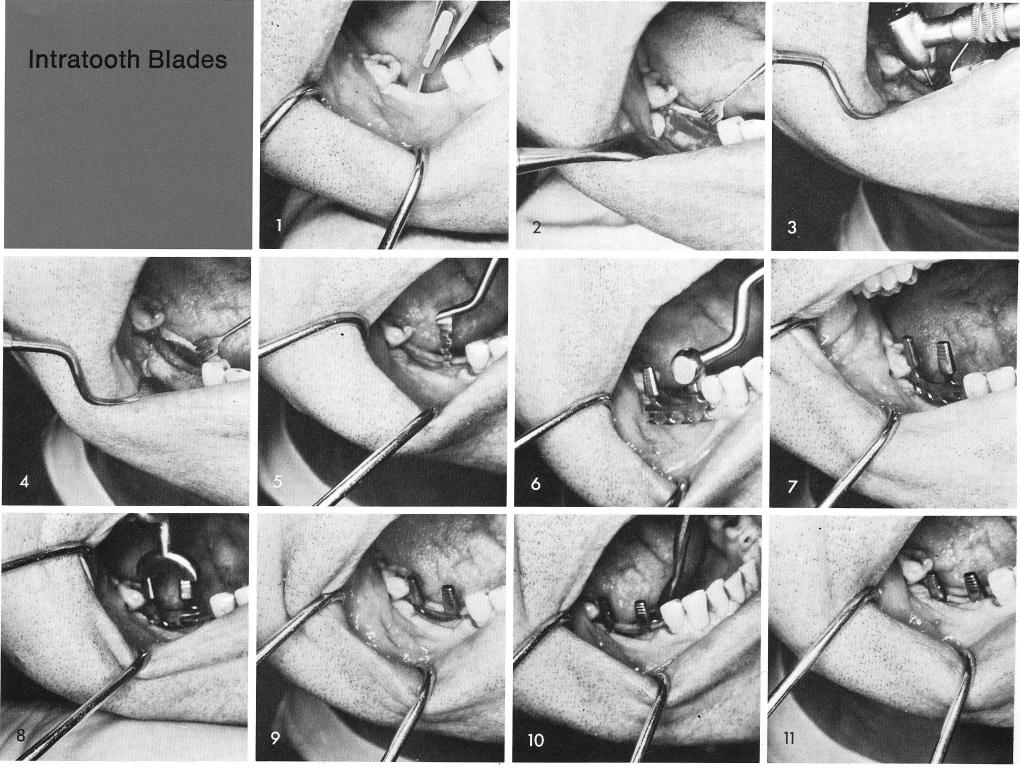 1 Intraoral incision lenght dictated by teeth approximating the incision