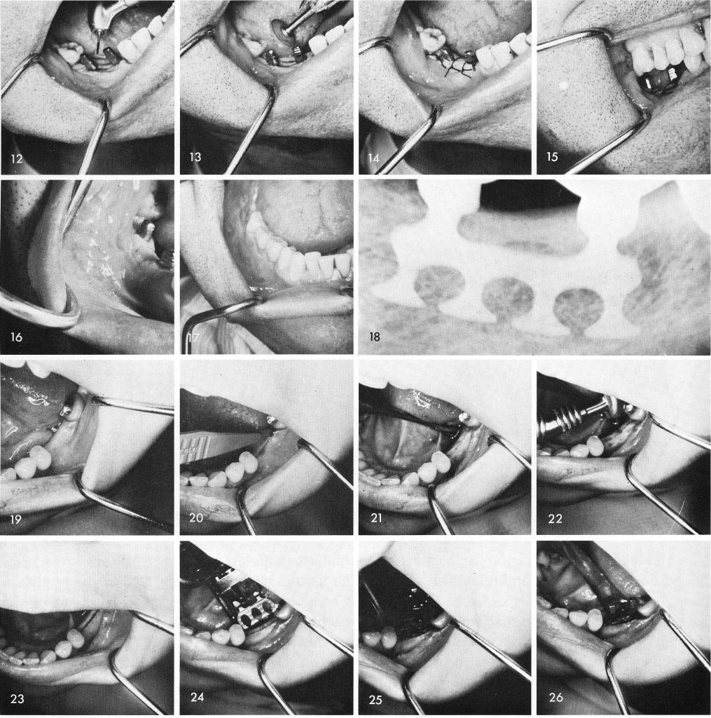 1 Mandibular Blade post implants are smoothed off with a rubber wheel