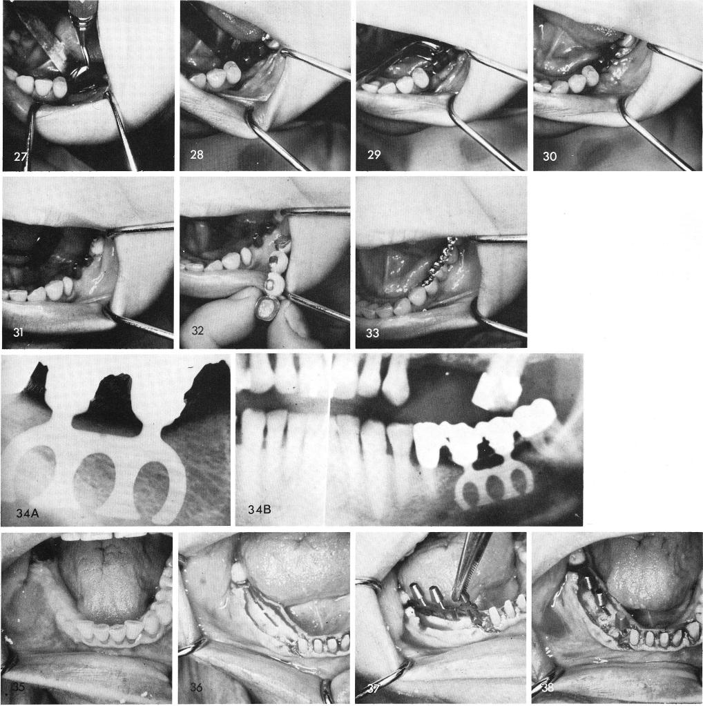 1 Four unit mandibular acrylic veneer bridge was fitted and cemented