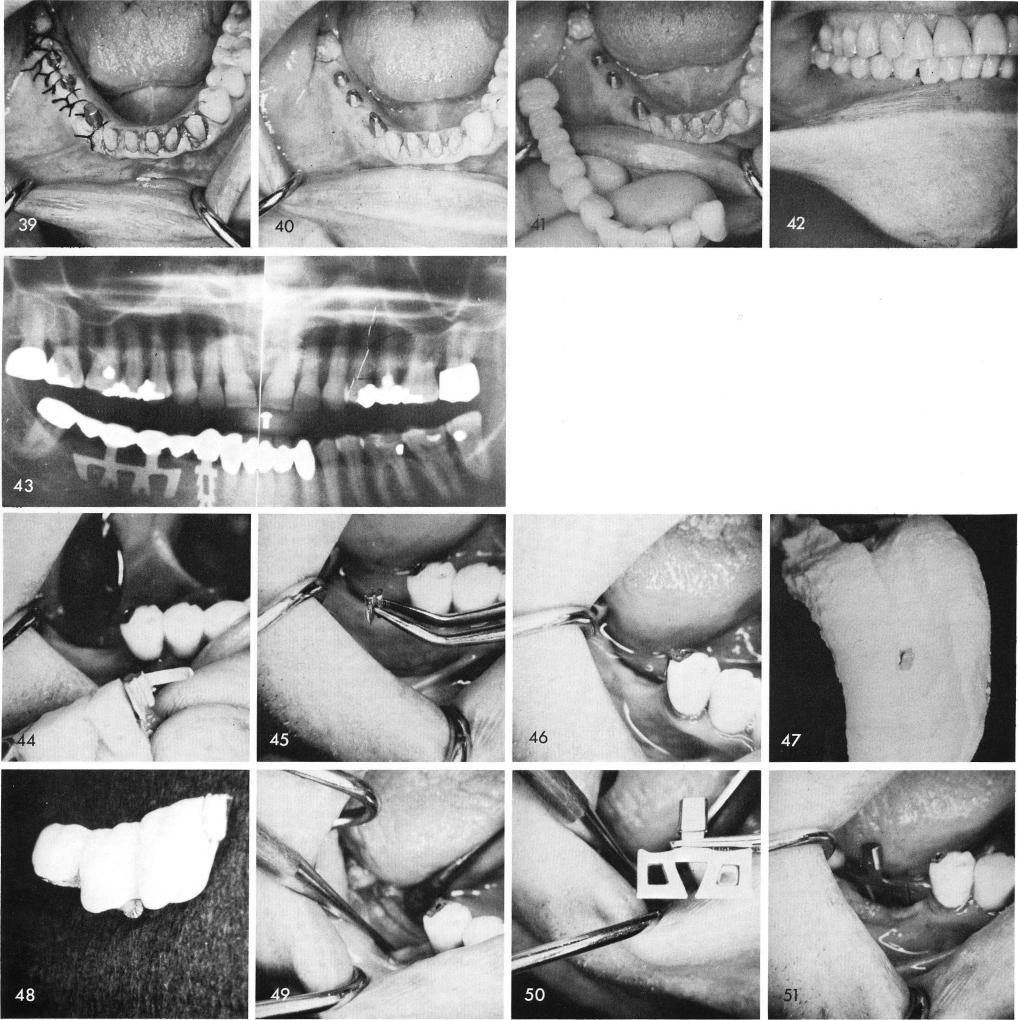 1 Final x-ray shows the completed case of two mandibular blade implants