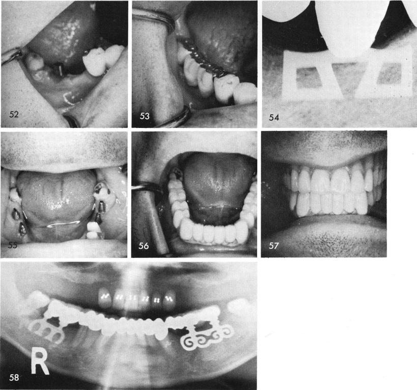 1 Tapping mandibular blade implant into its position