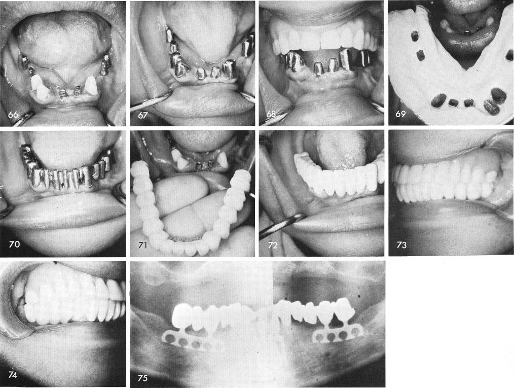 1 Interocclusal record of centric relationship for upper and lower jaws
