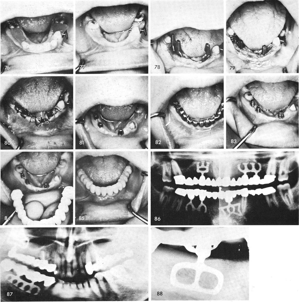 1 Tapping of two intratooth mandibular blade implants in knife-edged ridge