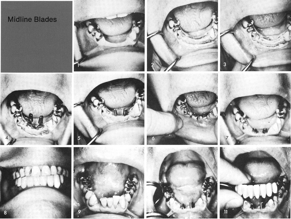 1 Mandibular midline blade insertion prior to grooving the bone