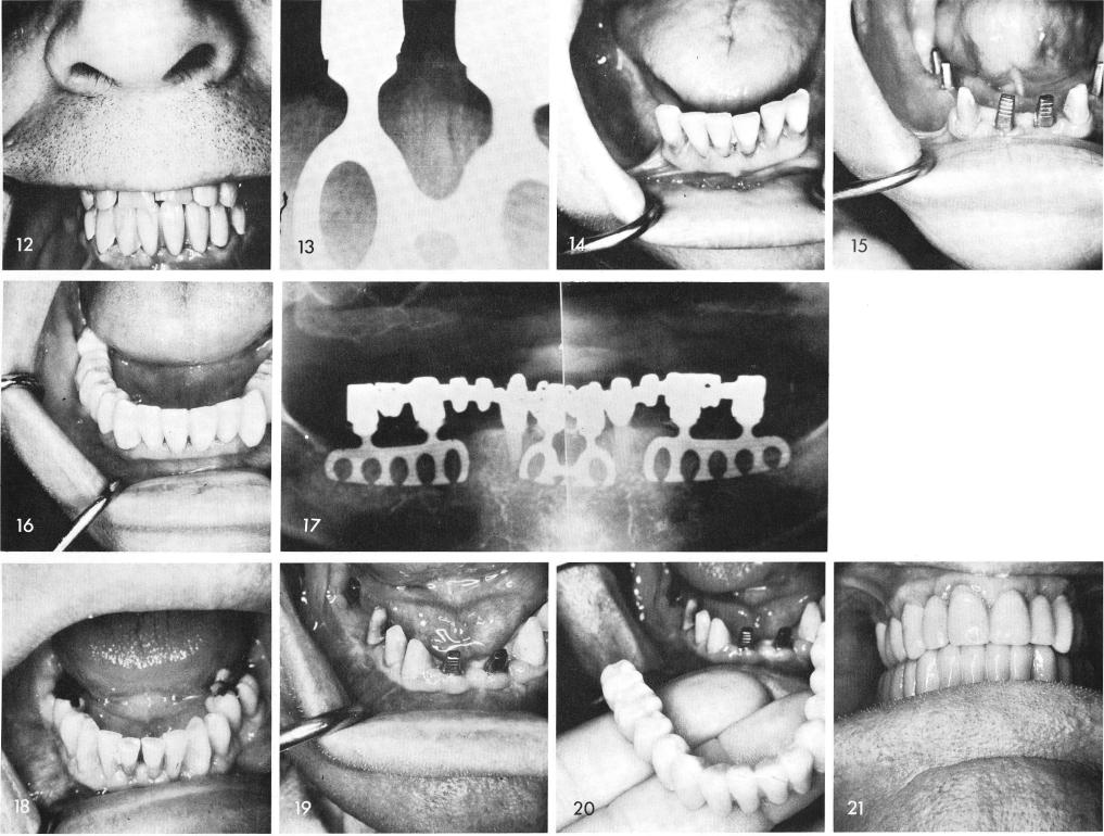 1 Periapical film of the midline blade in mandible
