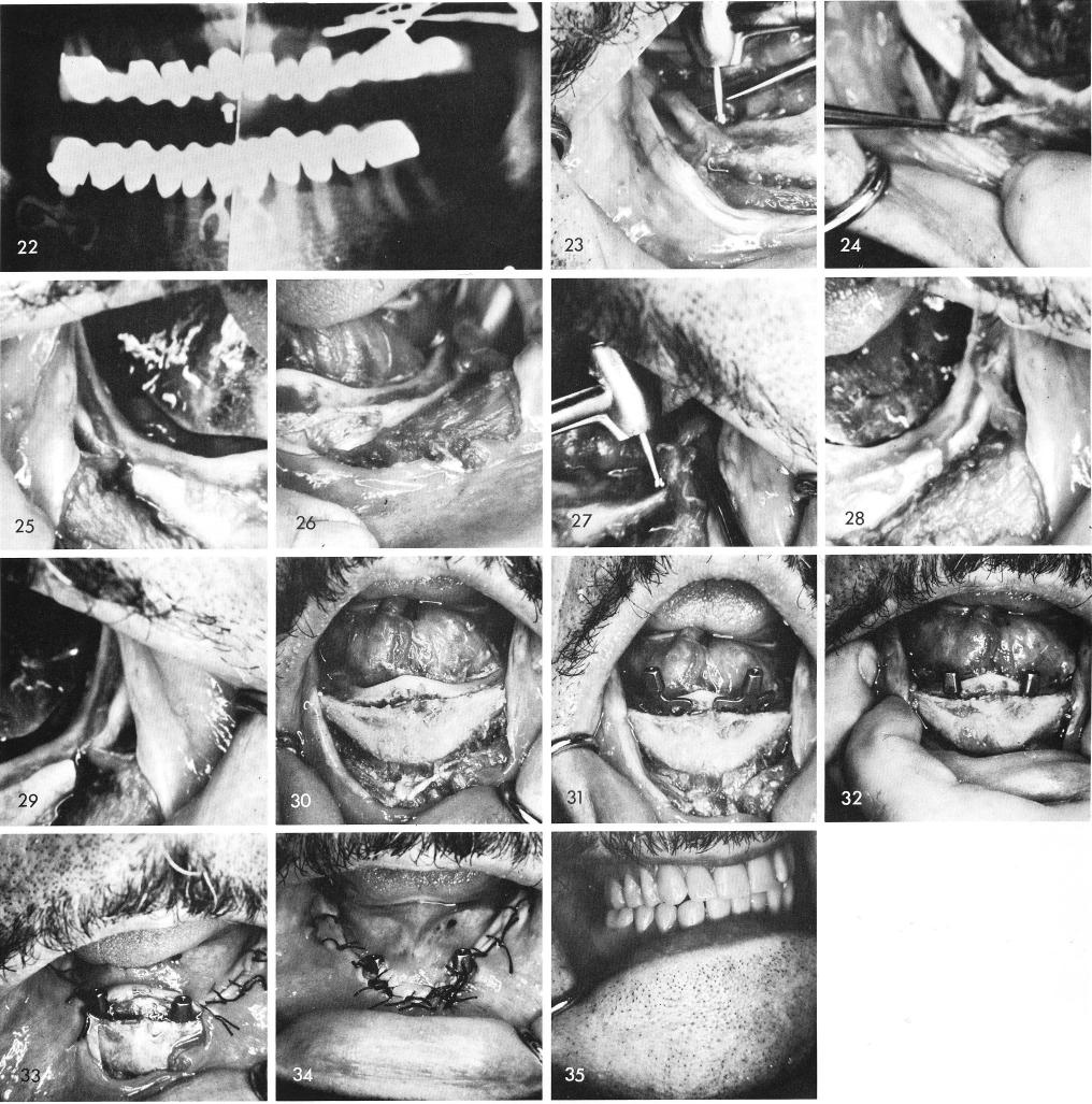 1 Exposed inferior alveolar nerves & mental bundles in resorbed mandible