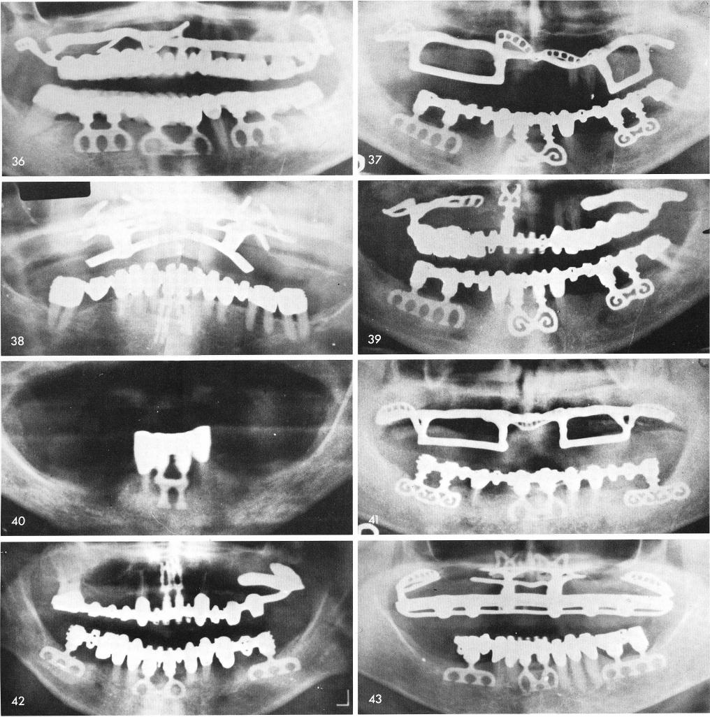 1 X rays of mandibular midline cases for implants