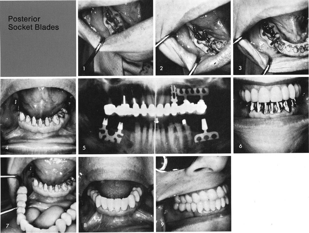 1 screw type or vitreous carbon or a bladevent implant in mandible