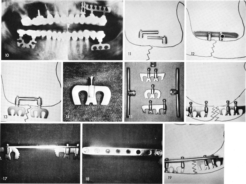 1 Solid round shaft and larger hollow tube coping for symphyseal fracture
