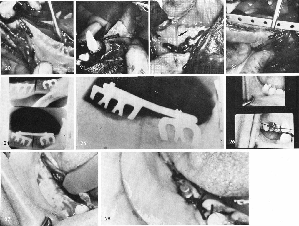 1 Mandibular blade implants splinted together using orthopedic bar 