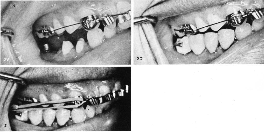 1 Inter maxillary rubber bands use for Class II division II malocclusion