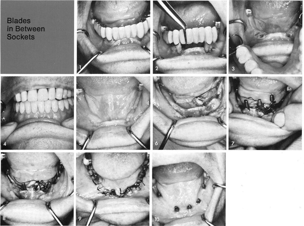 1 Immediate removable partial denture placed in mandible