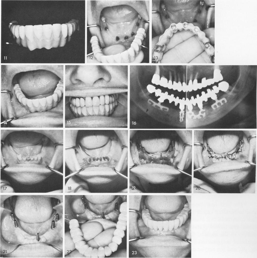 1 Insertion of intraseptal labio-lingual blade implant in deep sockets