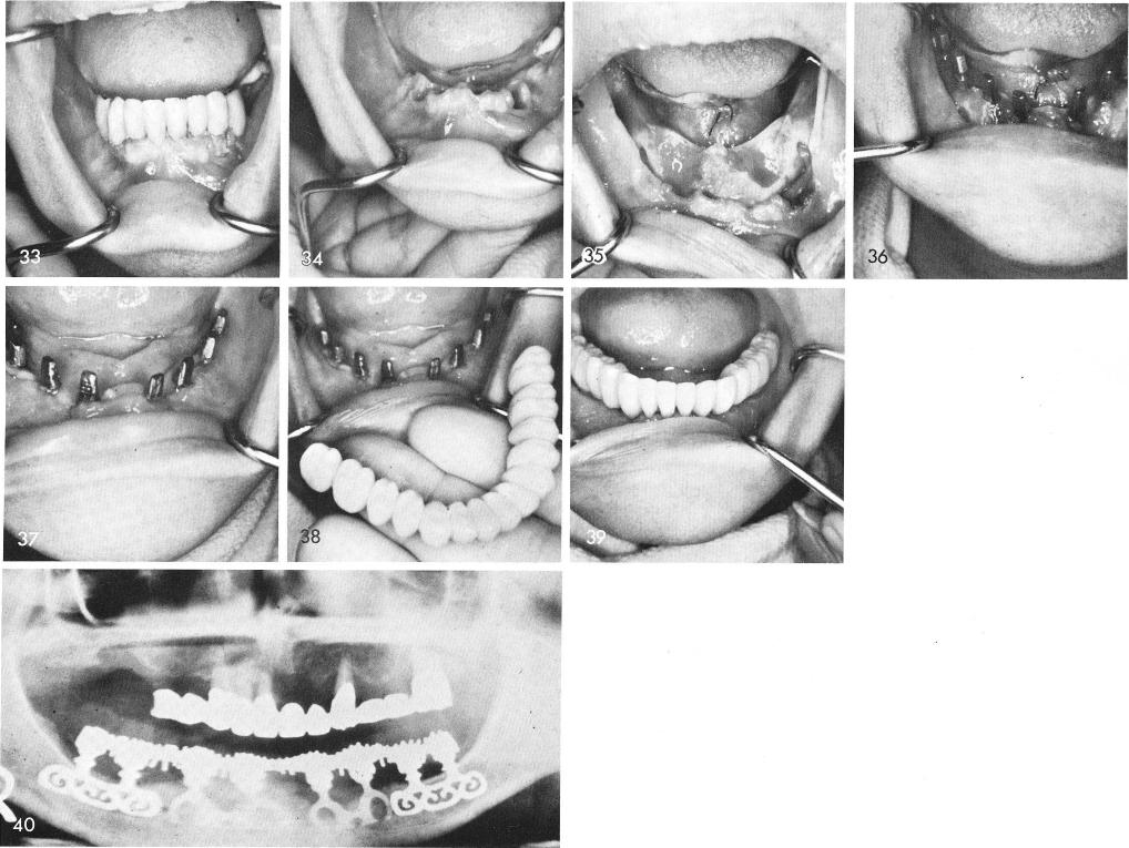 1 Case involving severely periodontally involved mouth