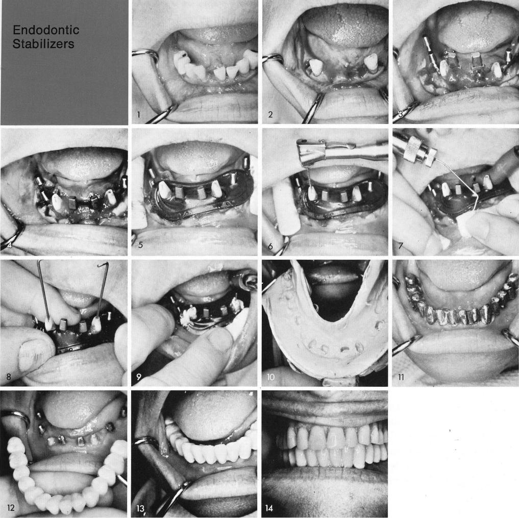 1 Case showing periodontally remaining mandibular cuspids