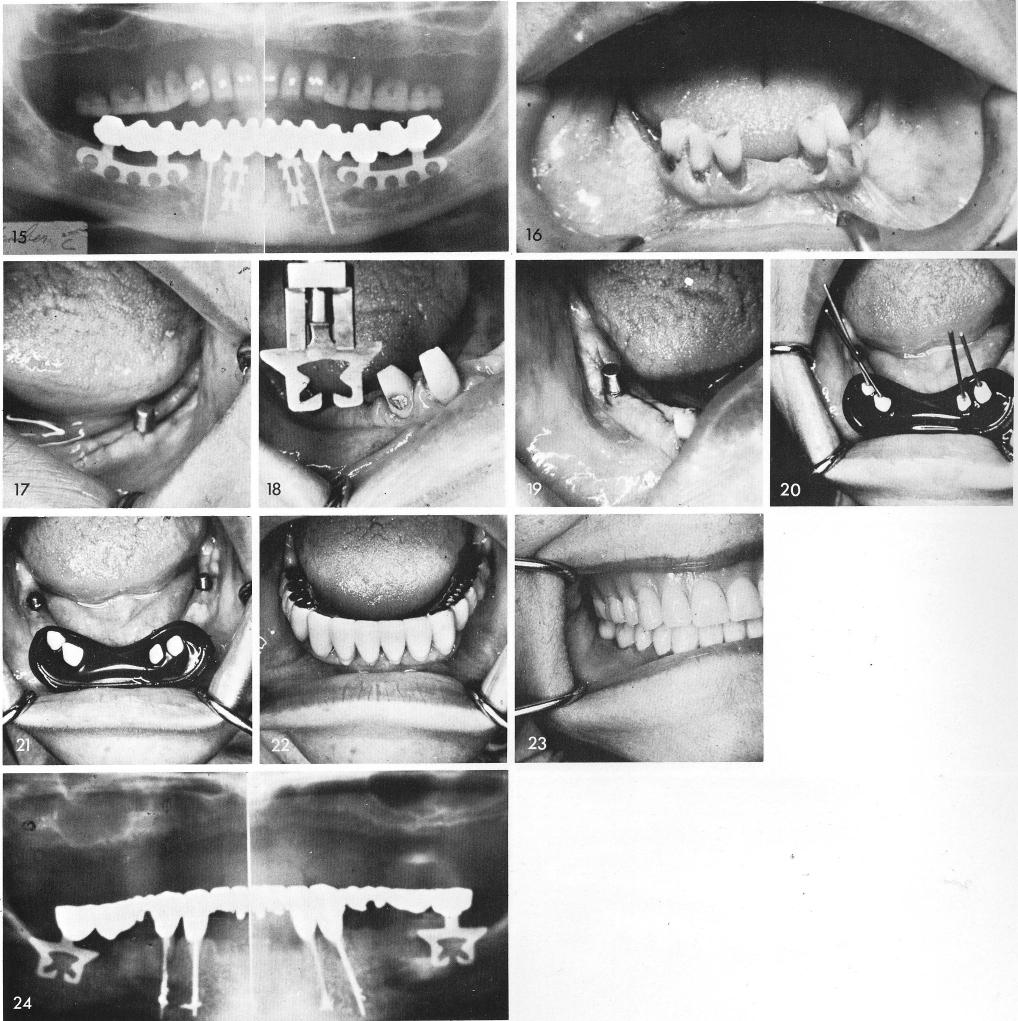 1 Mandibular knife edge ridges can accept implants