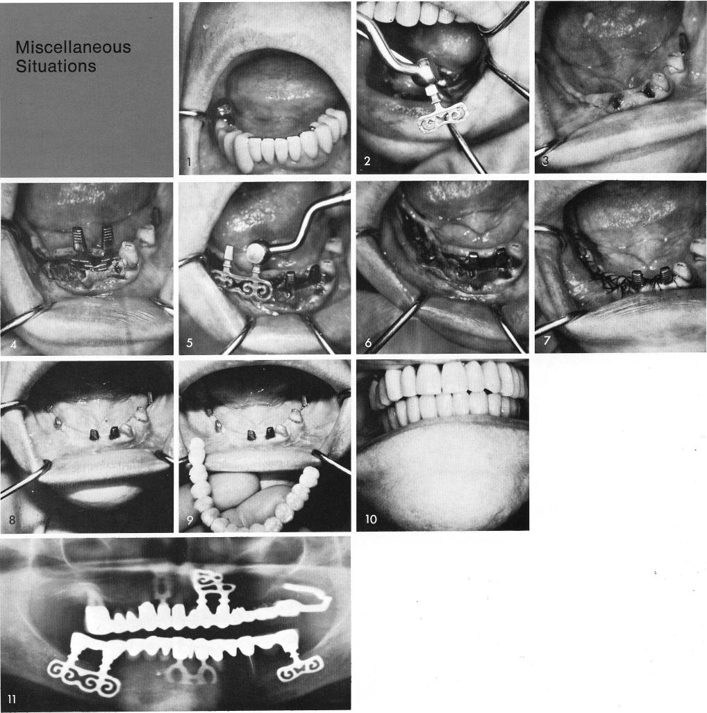 1 Removal of failing full arch mandibular fixed prosthesis