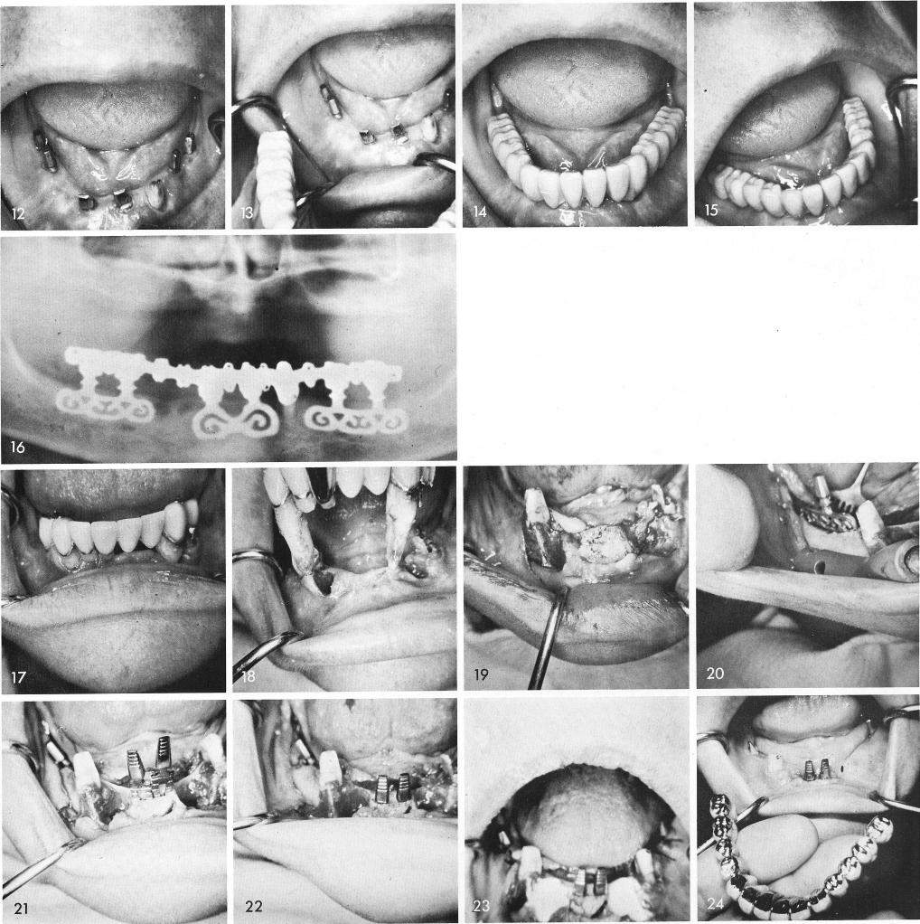 1 Blades inserted to give better support to fixed prosthesis 