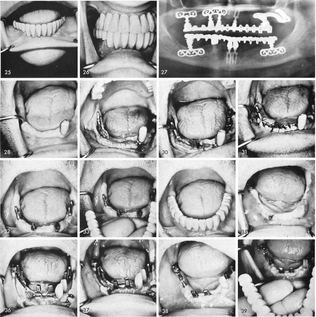 1 Periodontally involved cuspid replaced with fixed restoration