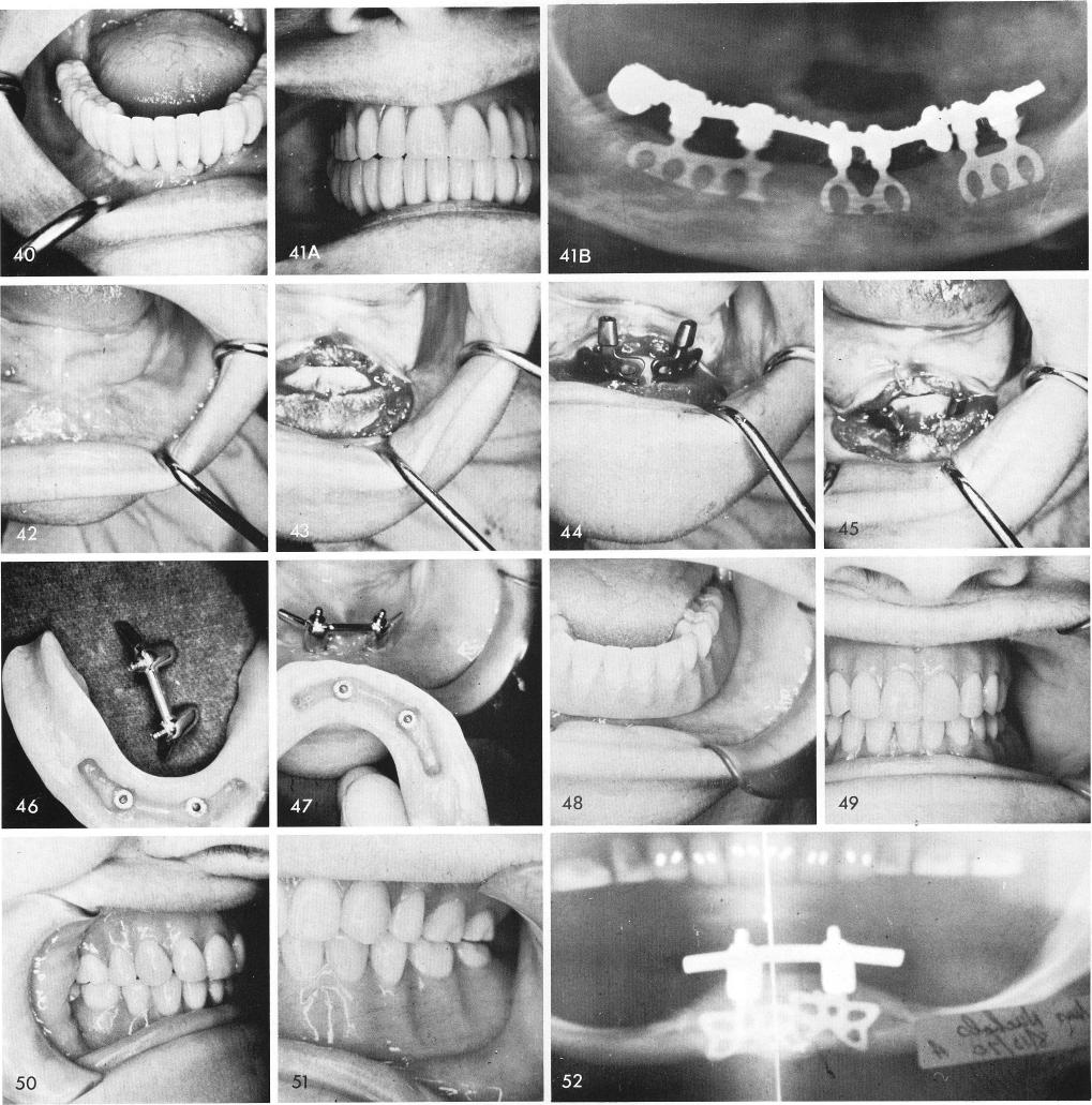 1 Splint the implant with Dolder bars and Gerber attachments