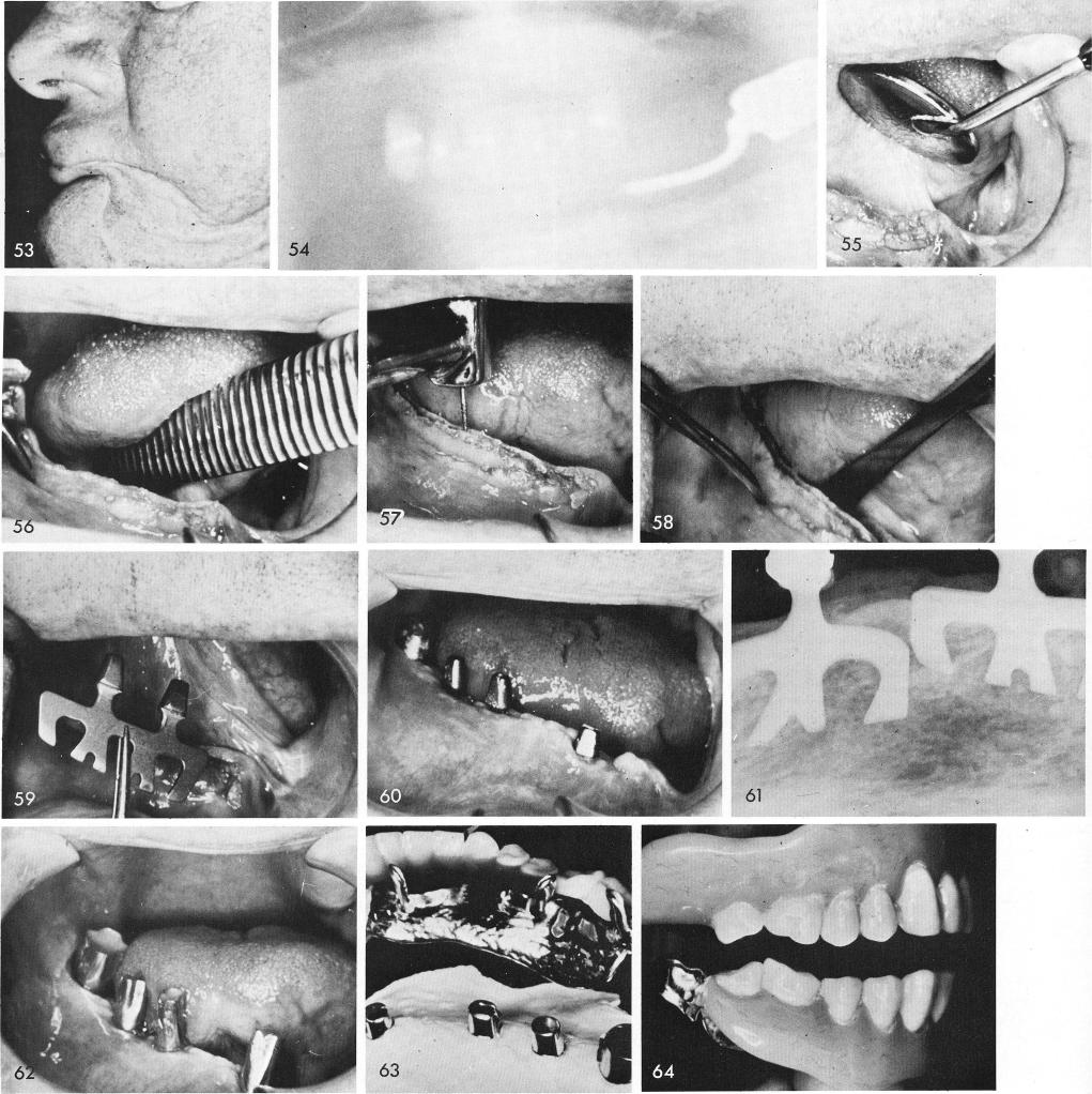 1 Blade implant placed after mandibular tooth extraction