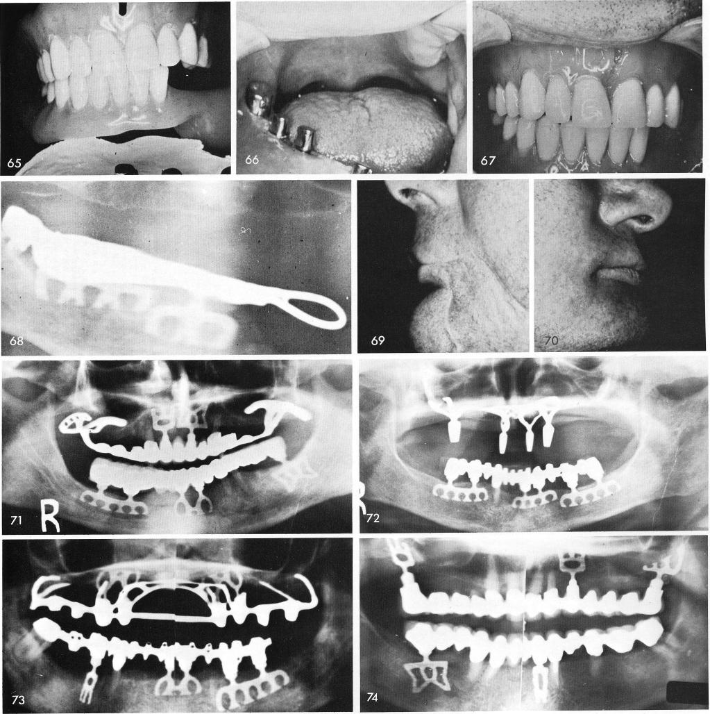 1  Gold coping cementation and telescopic coping over mandibular tooth