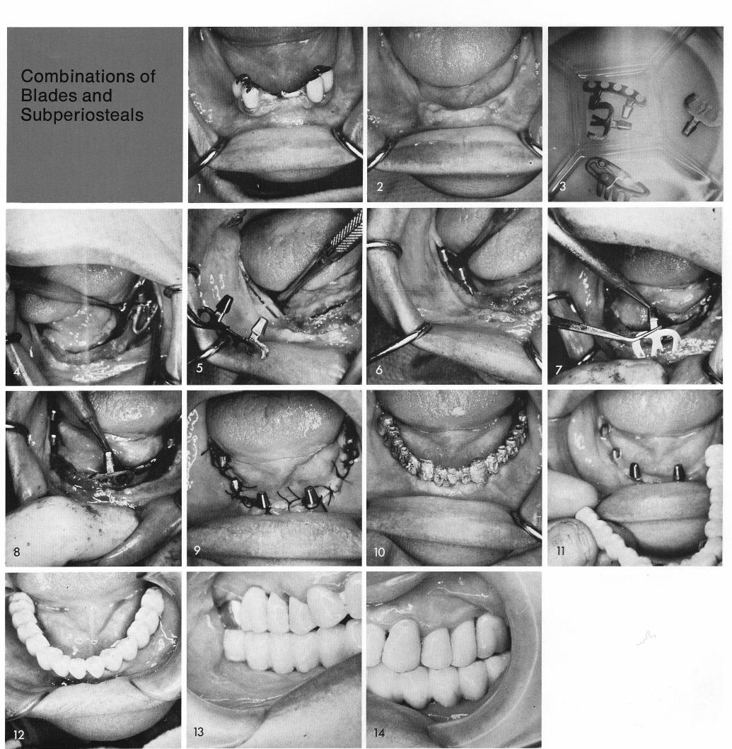 1 Partial bone impression for unilateral mandibular subperiosteal implant