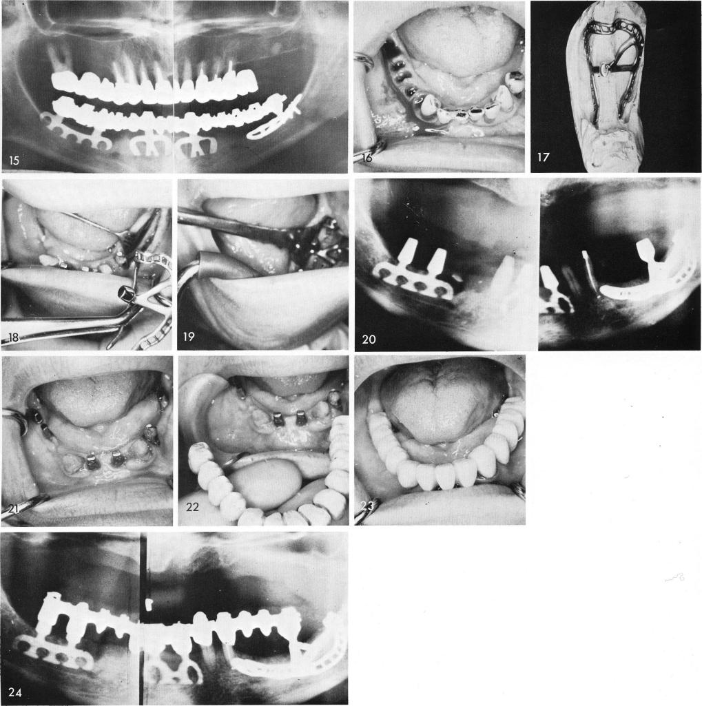 1 Post operative Xray of Mandibular subperiosteal and bladevent implants